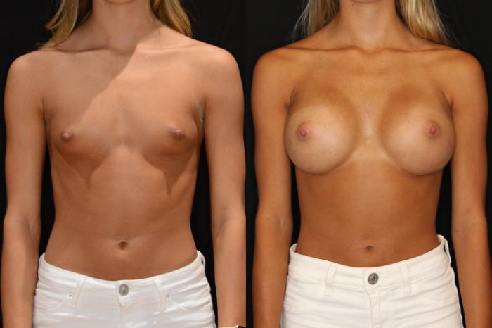 Before & After Breast Augmentation Case 574 View #1 View in Panama City & Pensacola, Florida