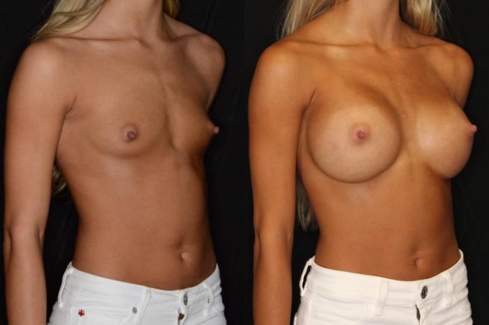 Before & After Breast Augmentation Case 575 View #1 View in Panama City & Pensacola, Florida