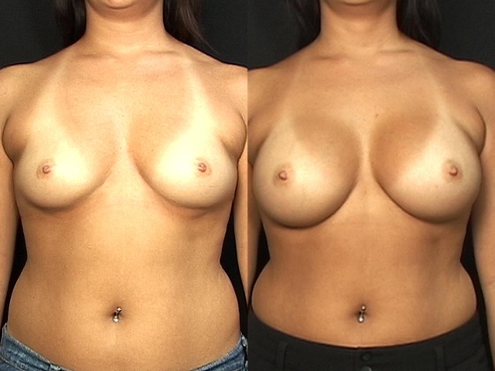 Before & After Breast Augmentation Case 578 View #1 View in Panama City & Pensacola, Florida
