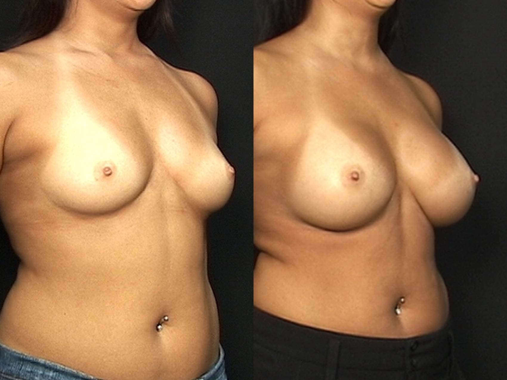 Before & After Breast Augmentation Case 579 View #1 View in Panama City & Pensacola, Florida