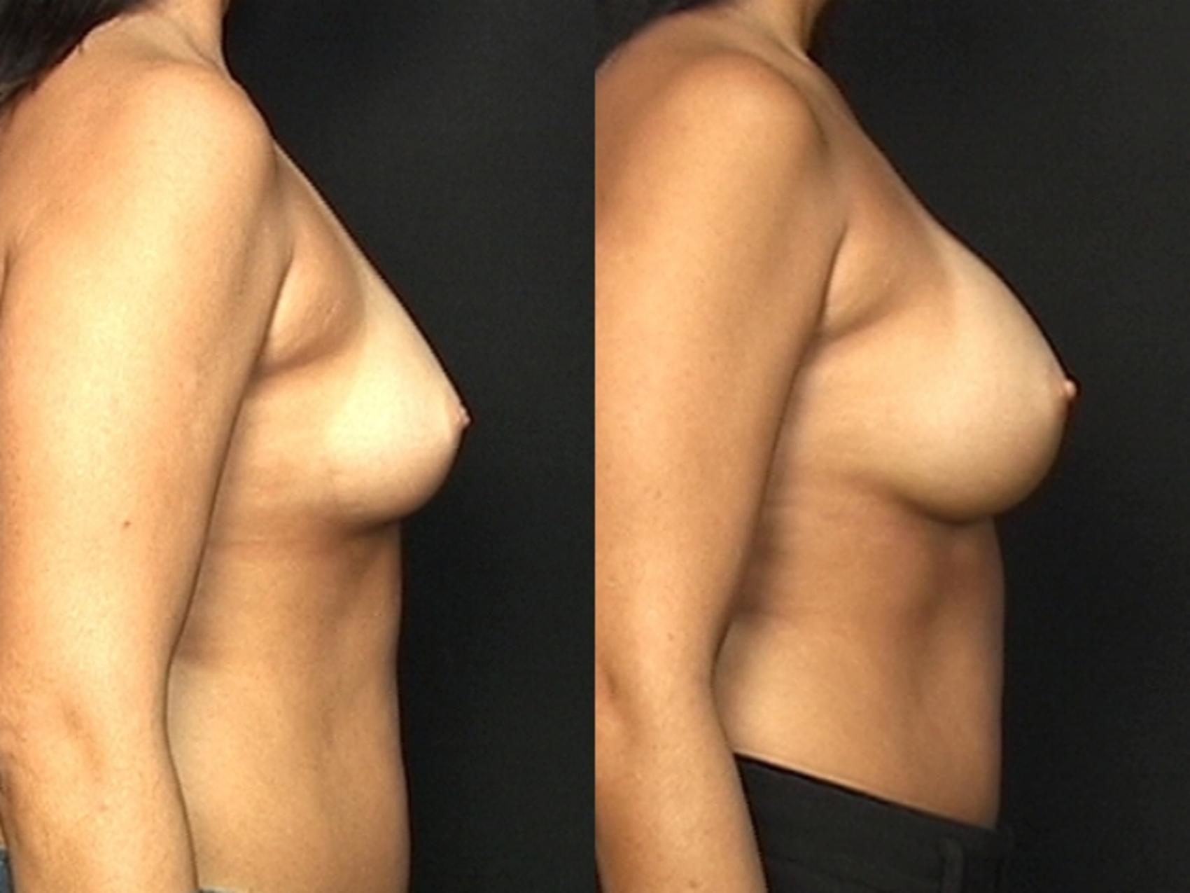 Before & After Breast Augmentation Case 580 View #1 View in Panama City & Pensacola, Florida