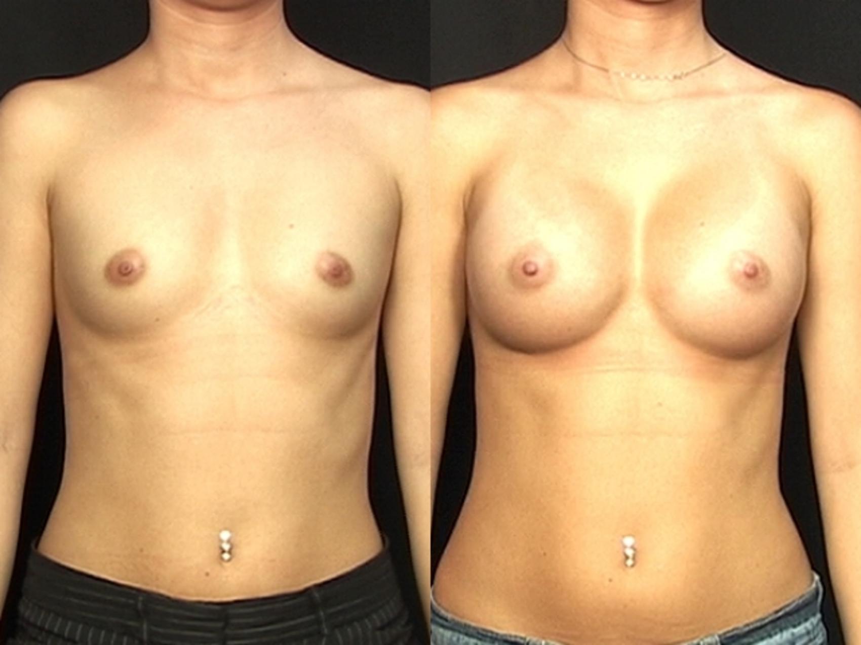 Before & After Breast Augmentation Case 581 View #1 View in Panama City & Pensacola, Florida
