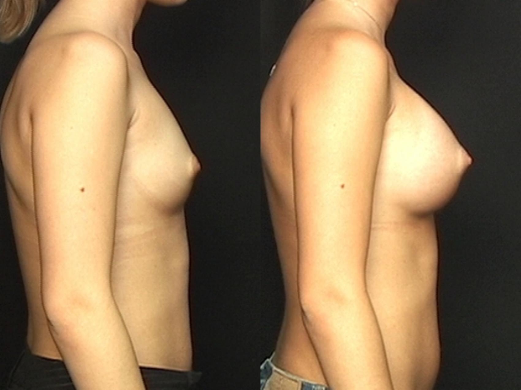 Before & After Breast Augmentation Case 582 View #1 View in Panama City & Pensacola, Florida