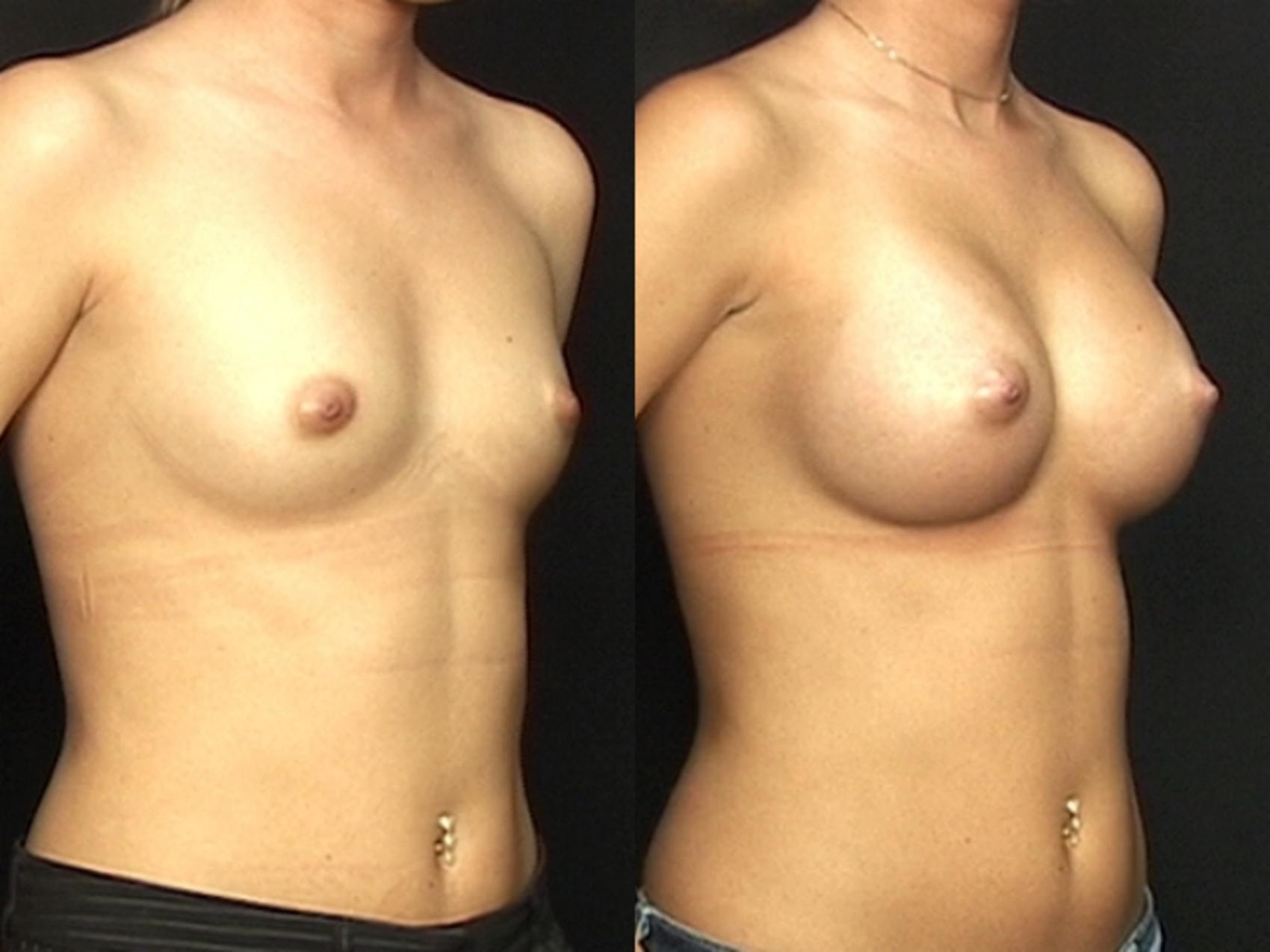 Before & After Breast Augmentation Case 583 View #1 View in Panama City & Pensacola, Florida