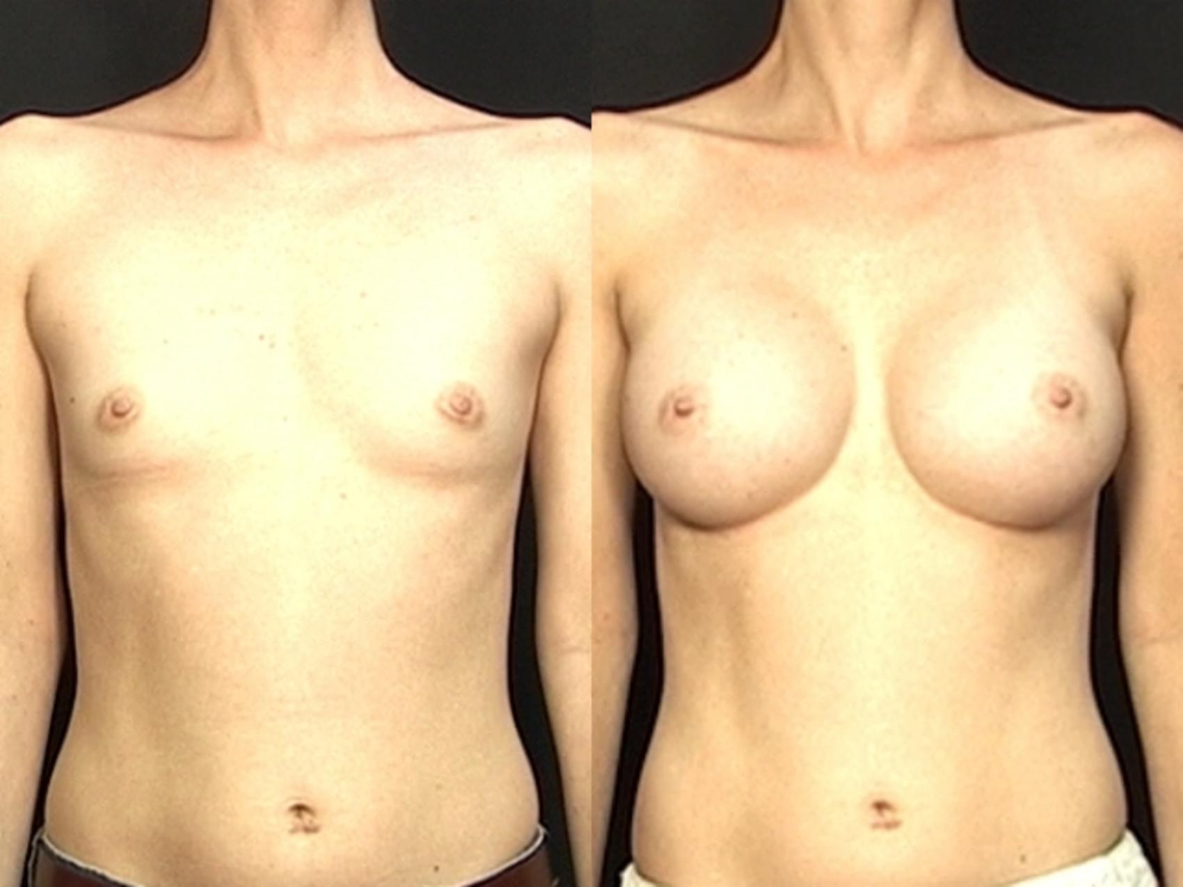 Before & After Breast Augmentation Case 584 View #1 View in Panama City & Pensacola, Florida