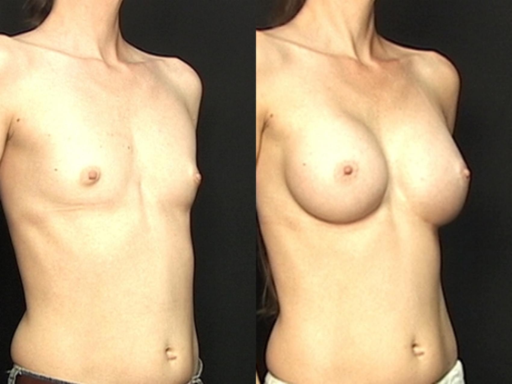 Before & After Breast Augmentation Case 585 View #1 View in Panama City & Pensacola, Florida