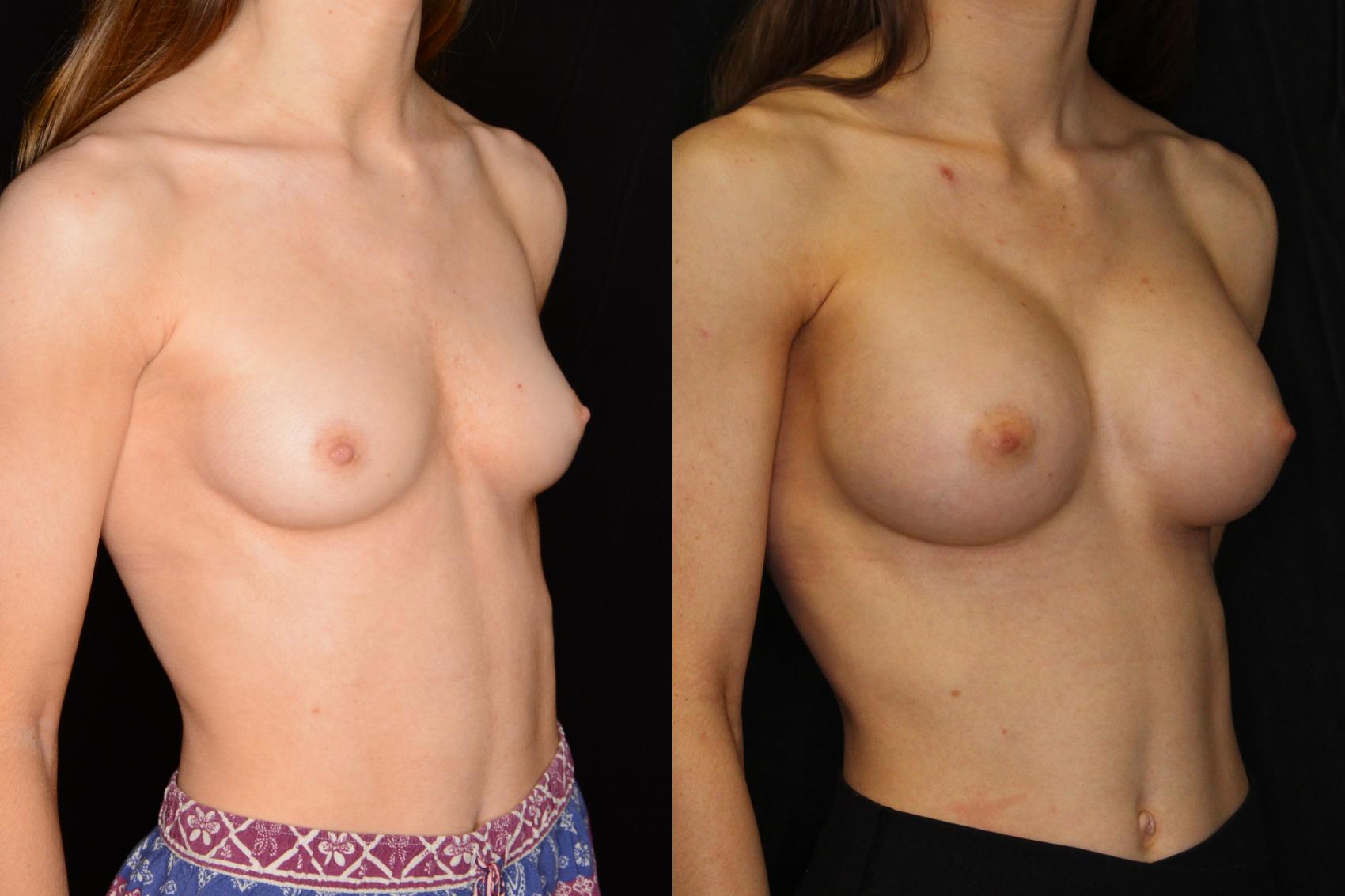 Before & After Breast Augmentation Case 607 View #1 View in Panama City & Pensacola, Florida