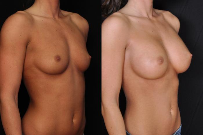 Before & After Breast Augmentation Case 610 View #1 View in Panama City & Pensacola, Florida