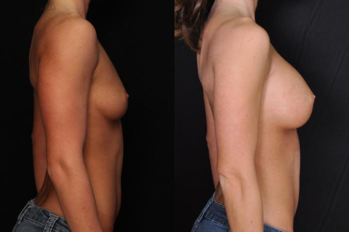 Before & After Breast Augmentation Case 611 View #1 View in Panama City & Pensacola, Florida