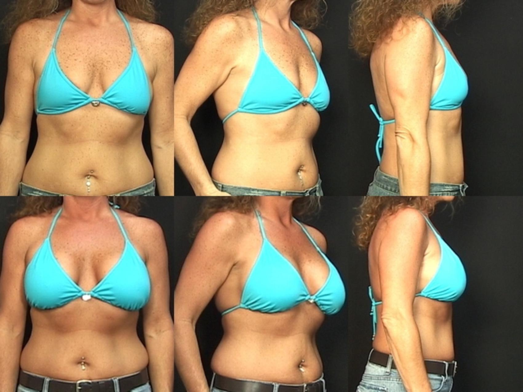 Before & After Breast Augmentation Case 76 View #2 View in Destin & Pensacola, Florida