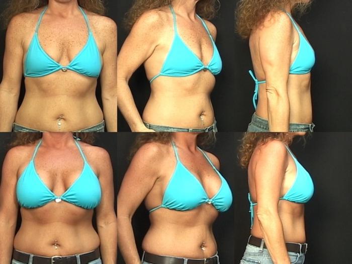 Before & After Breast Augmentation Case 76 View #2 View in Panama City & Pensacola, Florida