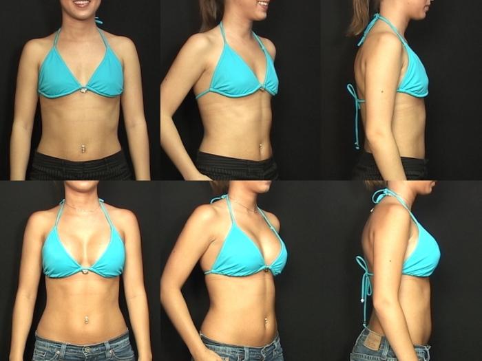 Before & After Breast Augmentation Case 79 View #2 View in Panama City & Pensacola, Florida