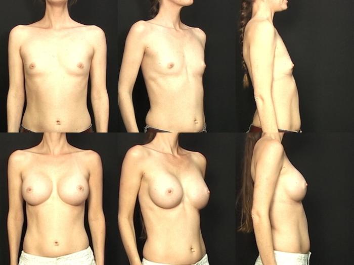 Before & After Breast Augmentation Case 84 View #1 View in Panama City & Pensacola, Florida