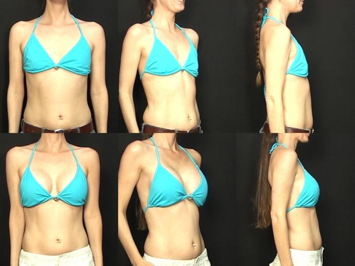 Before & After Breast Augmentation Case 84 View #2 View in Panama City & Pensacola, Florida