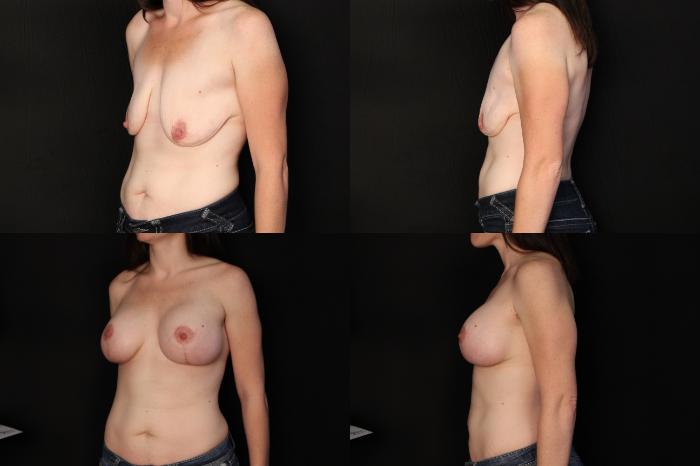 Before & After Breast Lift & Augmentation Case 444 View #2 View in Panama City & Pensacola, Florida