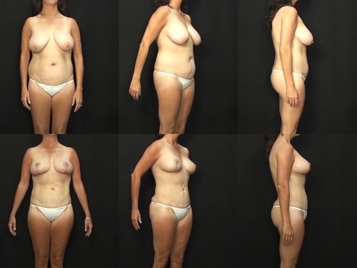 Before & After Breast Lift (Mastopexy) Case 251 View #1 View in Panama City & Pensacola, Florida
