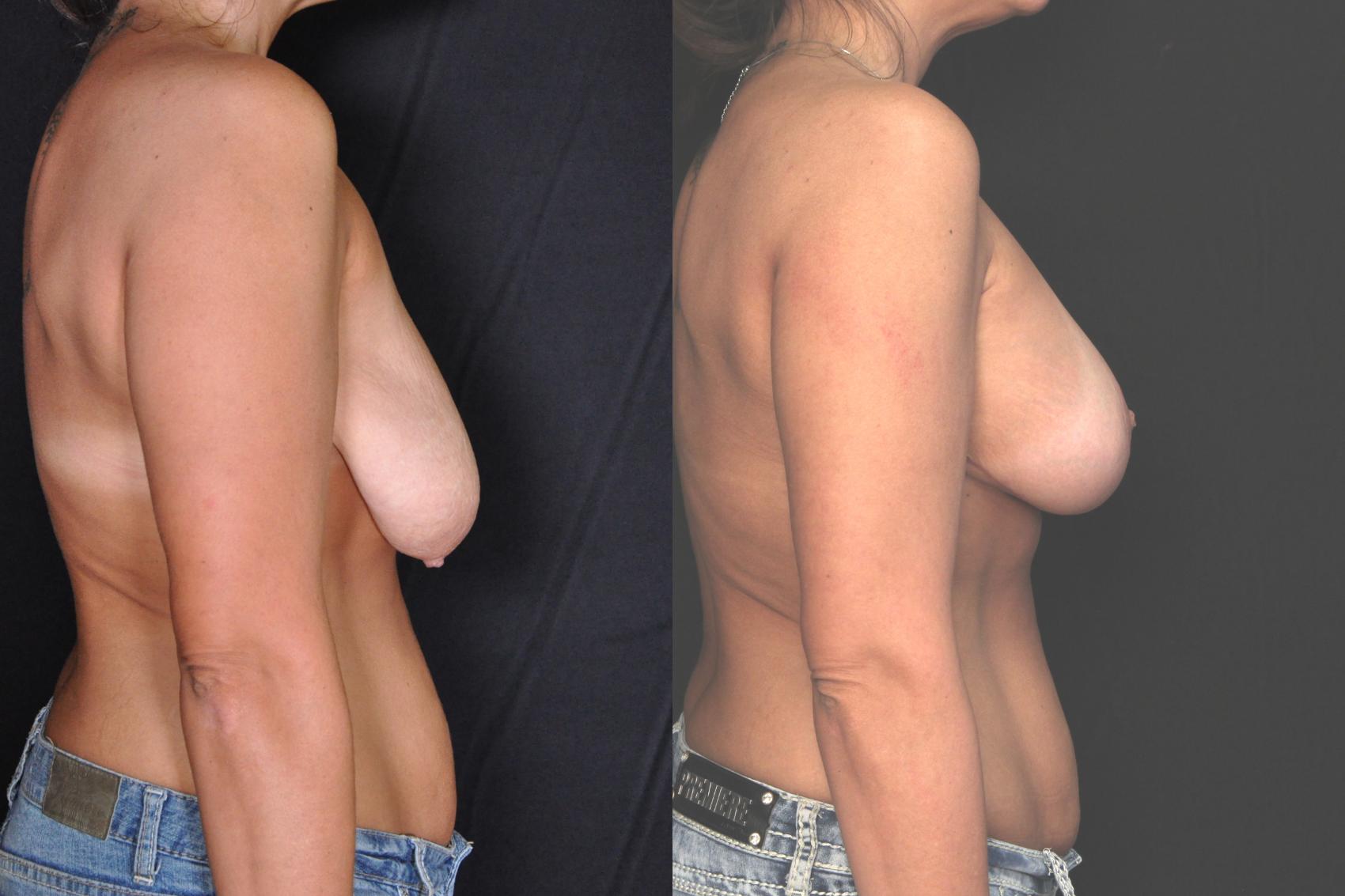 Before & After Breast Lift (Mastopexy) Case 604 View #1 View in Panama City & Pensacola, Florida