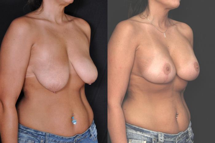 Before & After Breast Lift (Mastopexy) Case 605 View #1 View in Panama City & Pensacola, Florida
