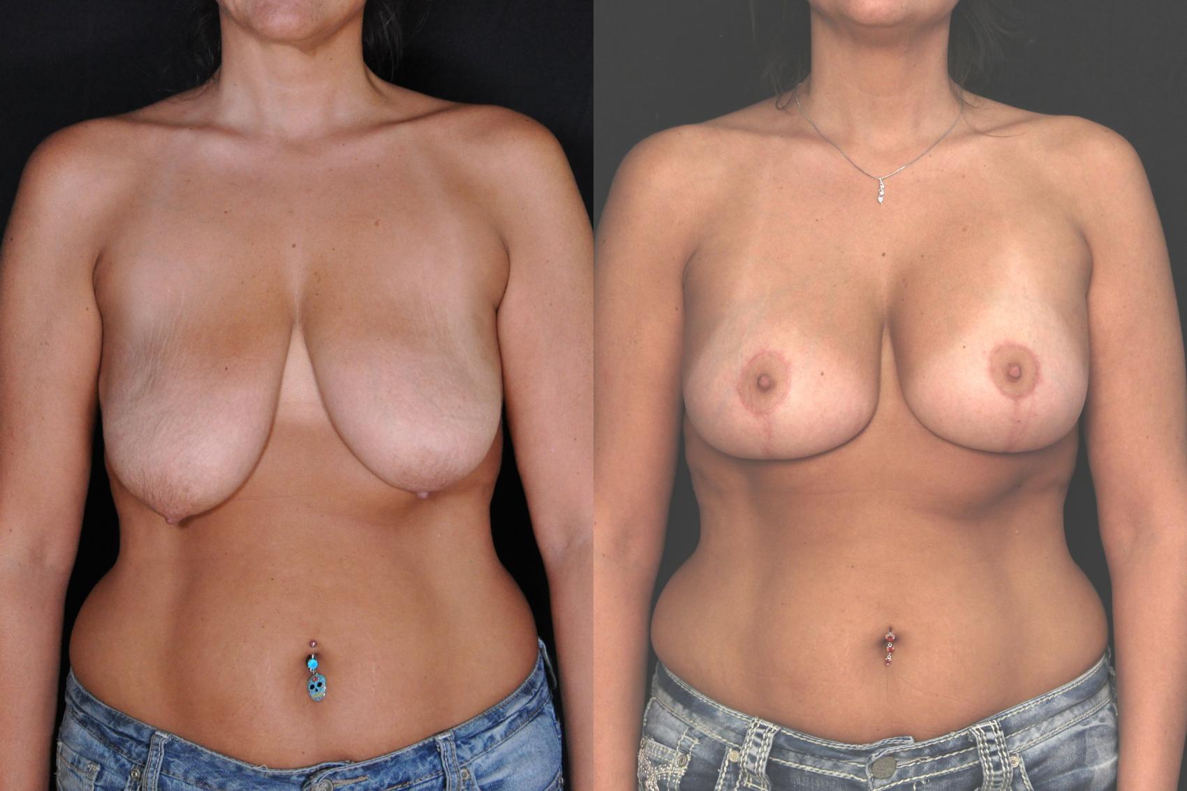 Before & After Breast Lift (Mastopexy) Case 606 View #1 View in Panama City & Pensacola, Florida
