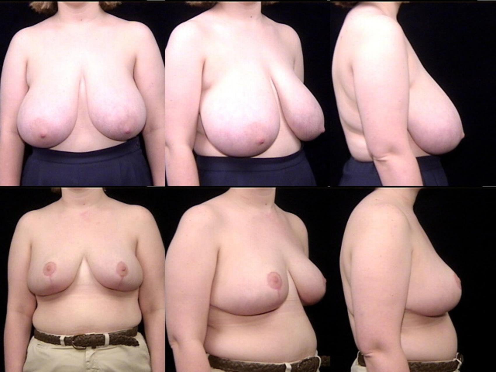 Before & After Breast Reduction Case 232 View #1 View in Panama City & Pensacola, Florida