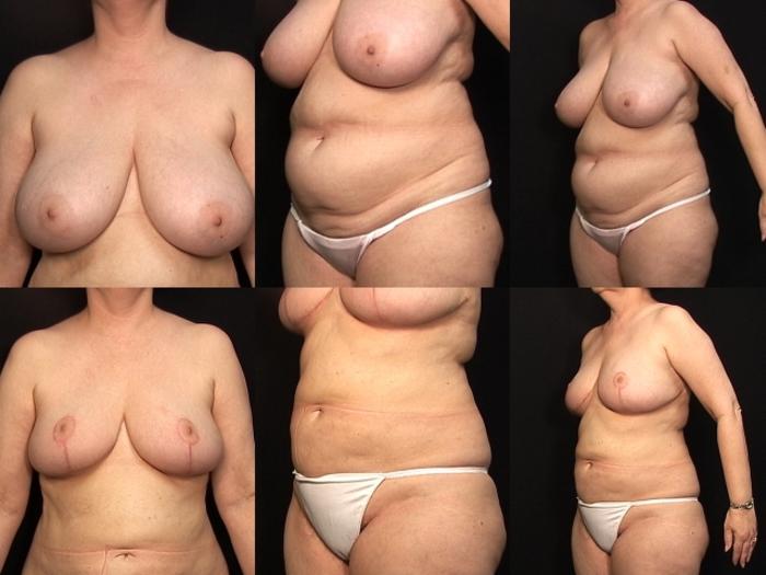 Before & After Breast Reduction Case 233 View #1 View in Panama City & Pensacola, Florida