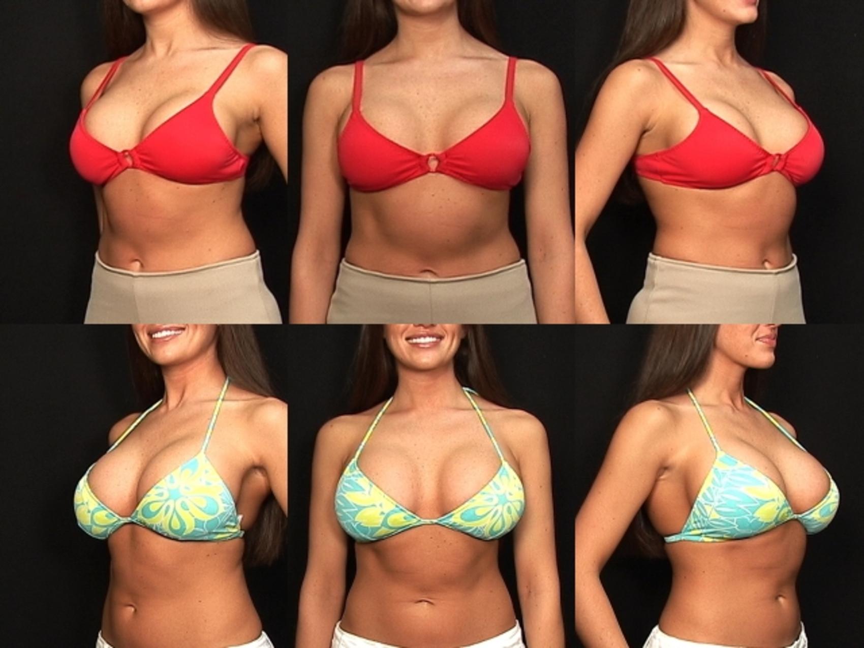 Before & After Breast Revision Case 418 View #2 View in Destin & Pensacola, Florida