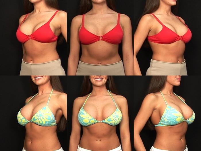 Before & After Breast Revision Case 418 View #2 View in Panama City & Pensacola, Florida