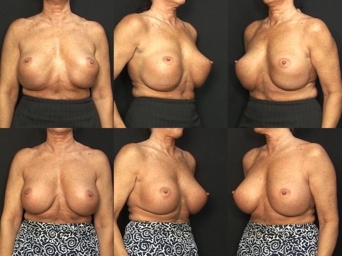 Before & After Breast Revision Case 419 View #1 View in Panama City & Pensacola, Florida