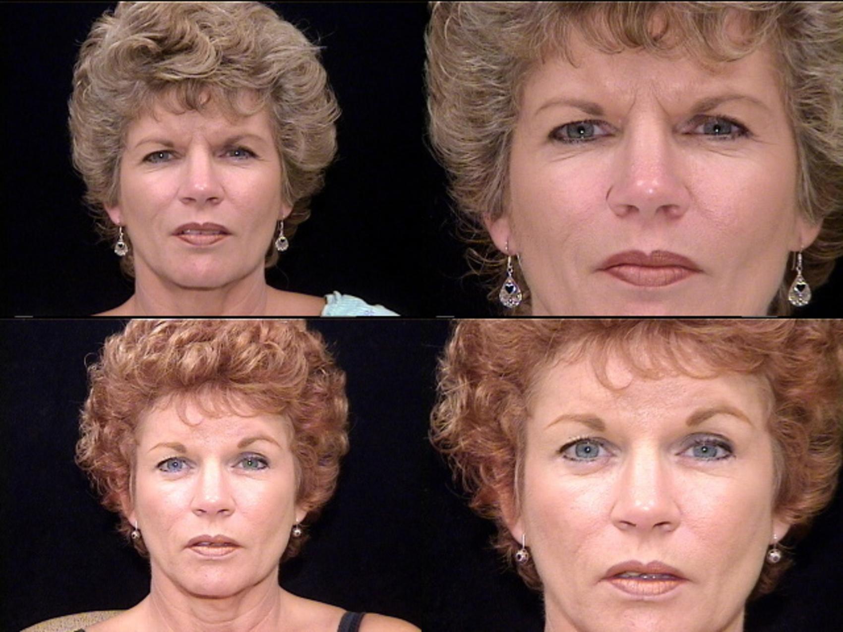 Before & After Browlift Case 272 View #1 View in Panama City & Pensacola, Florida