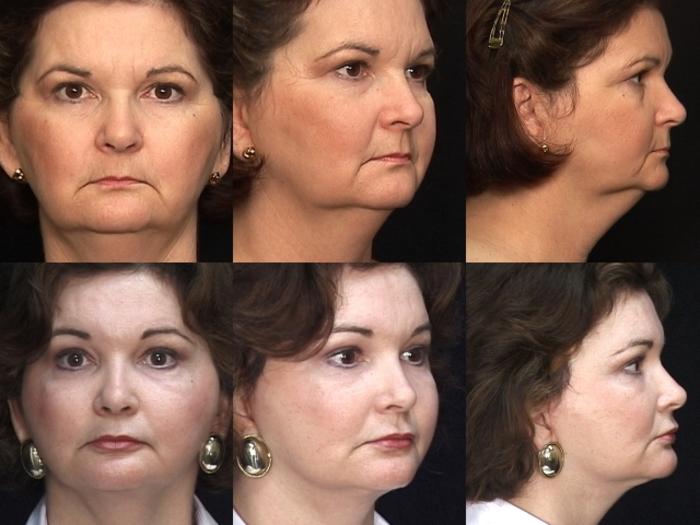 Before & After Browlift Case 57 View #1 View in Panama City & Pensacola, Florida