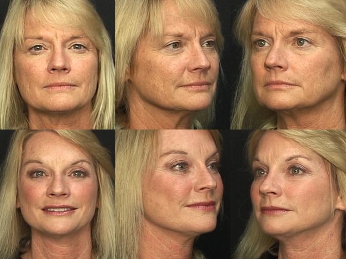 Before & After Browlift Case 63 View #1 View in Panama City & Pensacola, Florida