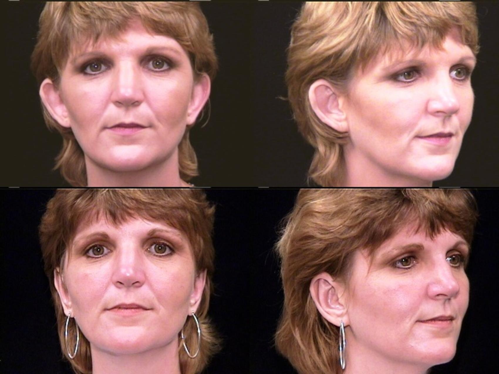 Before & After Ear Surgery (Otoplasty) Case 15 View #1 View in Panama City & Pensacola, Florida