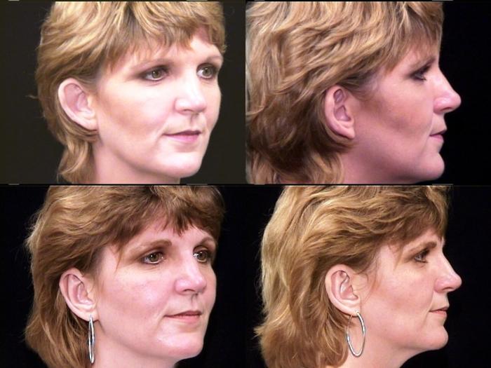 Before & After Ear Surgery (Otoplasty) Case 15 View #2 View in Panama City & Pensacola, Florida