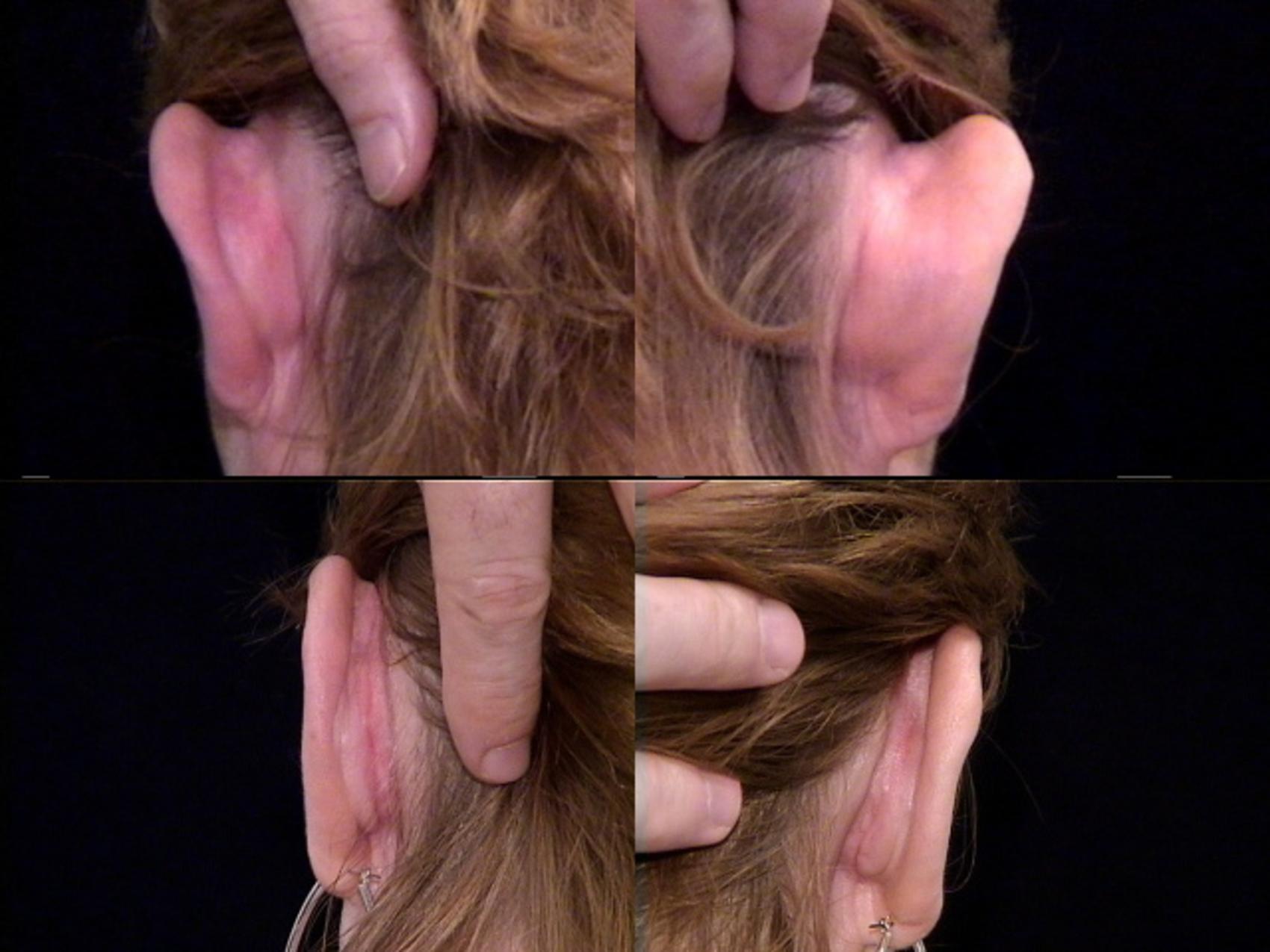 Before & After Ear Surgery (Otoplasty) Case 15 View #3 View in Destin & Pensacola, Florida