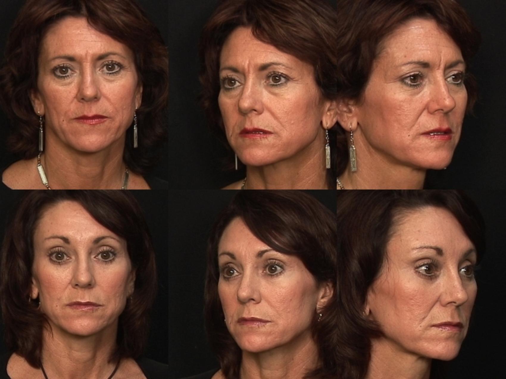 Before & After Eyelid Surgery Case 267 View #1 View in Panama City & Pensacola, Florida