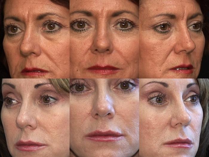 Before & After Eyelid Surgery Case 267 View #2 View in Panama City & Pensacola, Florida