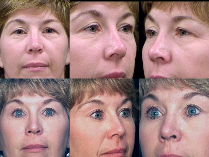 Before & After Eyelid Surgery Case 269 View #1 View in Panama City & Pensacola, Florida