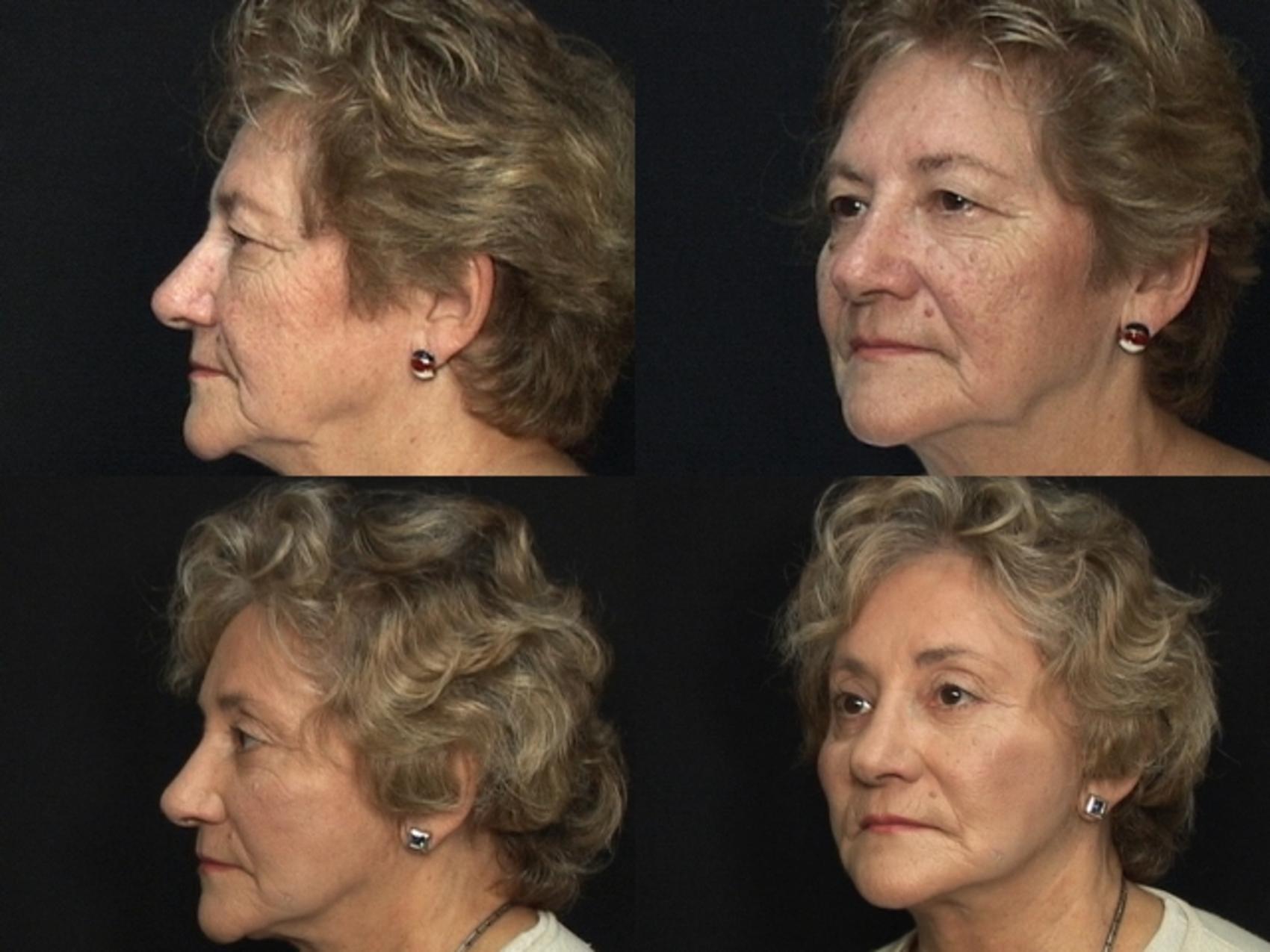 Before & After Eyelid Surgery Case 59 View #1 View in Panama City & Pensacola, Florida