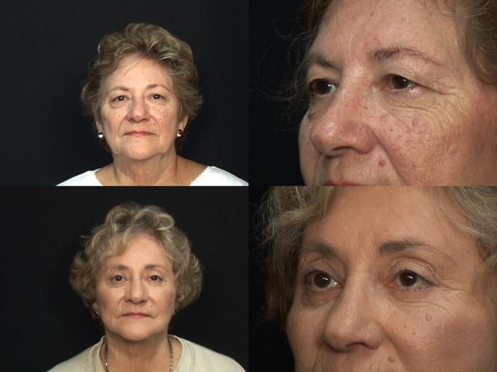 Before & After Eyelid Surgery Case 59 View #3 View in Panama City & Pensacola, Florida