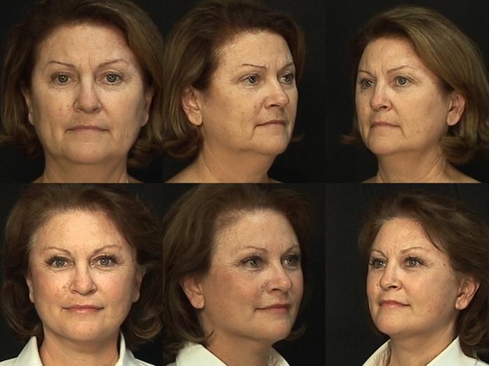 Before & After Facelift Case 217 View #1 View in Panama City & Pensacola, Florida