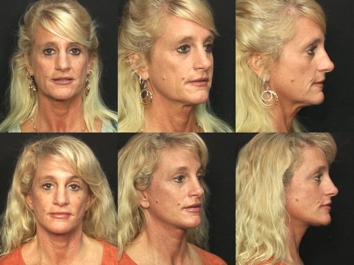 Before & After Facelift Case 263 View #1 View in Panama City & Pensacola, Florida