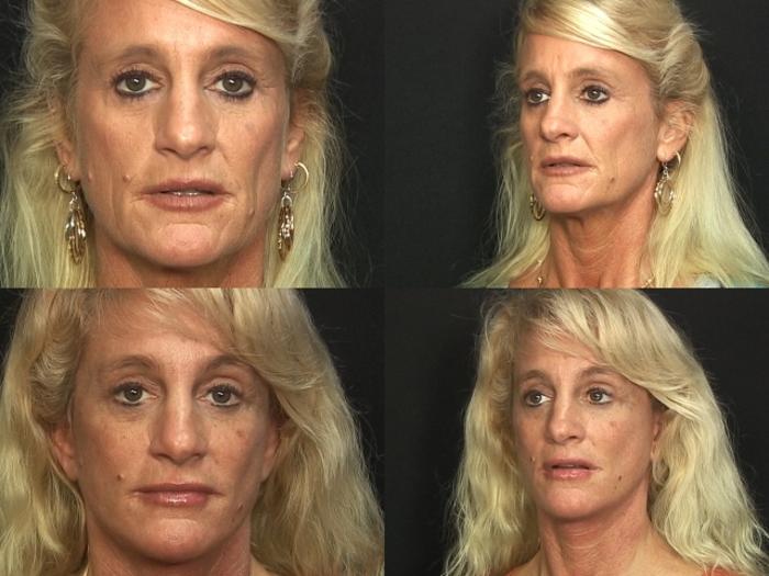 Before & After Facelift Case 263 View #2 View in Panama City & Pensacola, Florida