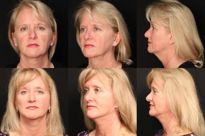 Before & After Facelift Case 439 View #1 View in Panama City & Pensacola, Florida