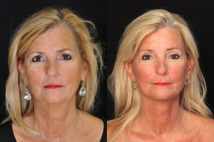 Before & After Facelift Case 517 View #1 View in Panama City & Pensacola, Florida