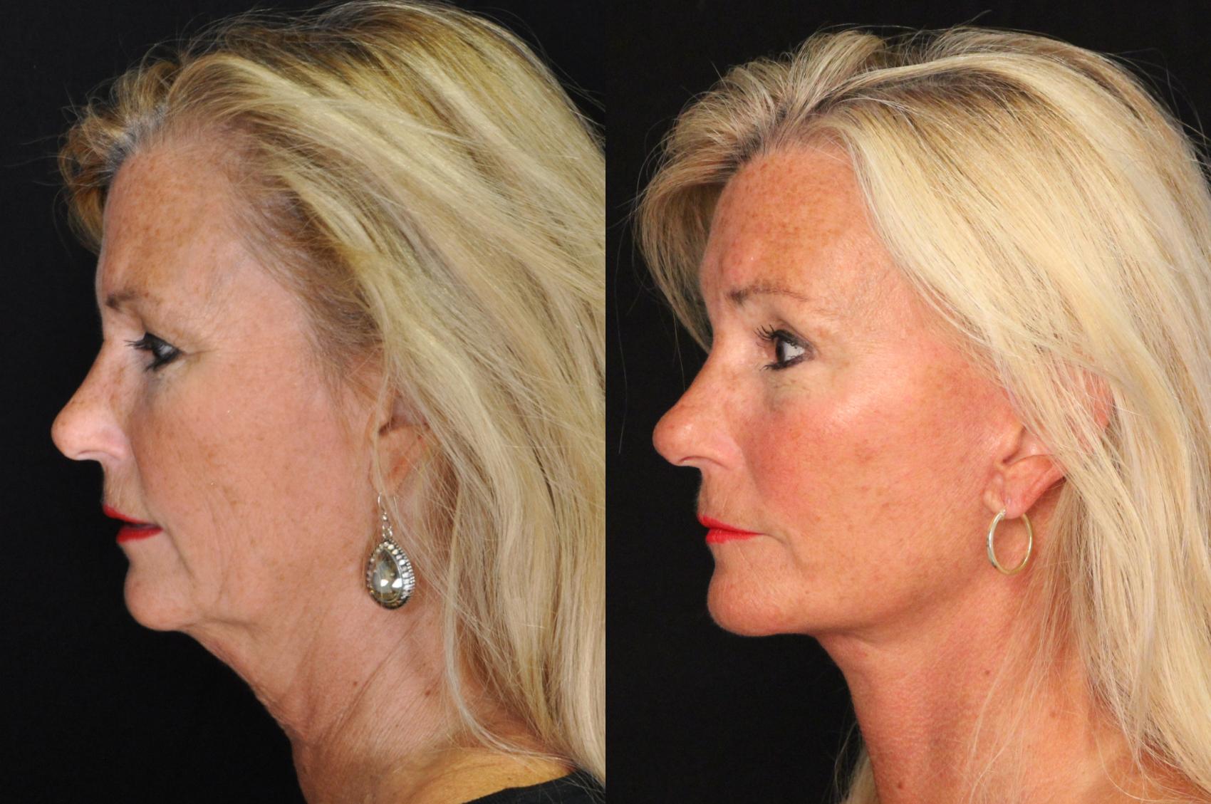 Before & After Facelift Case 518 View #1 View in Panama City & Pensacola, Florida