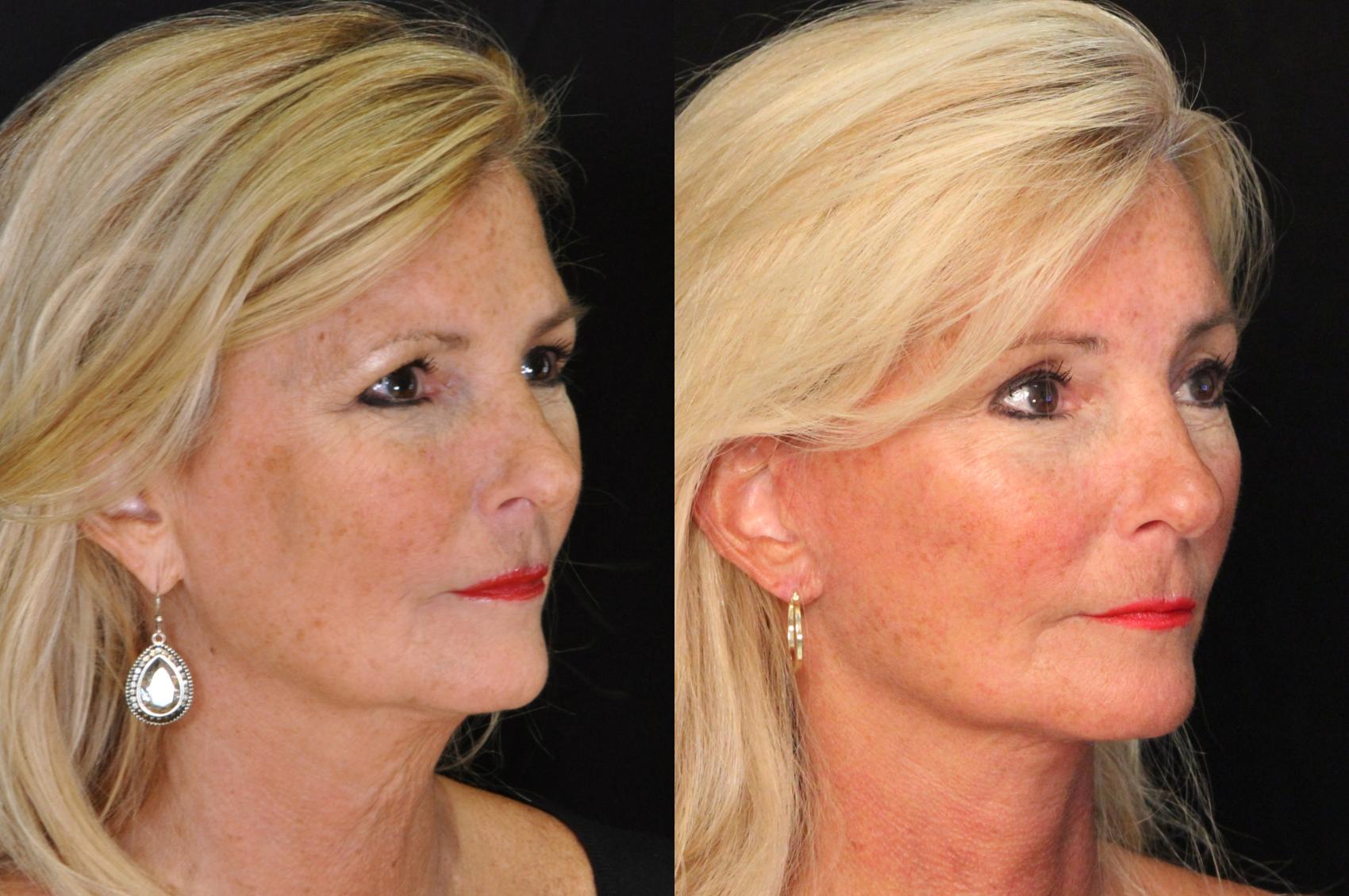 Before & After Facelift Case 519 View #1 View in Panama City & Pensacola, Florida