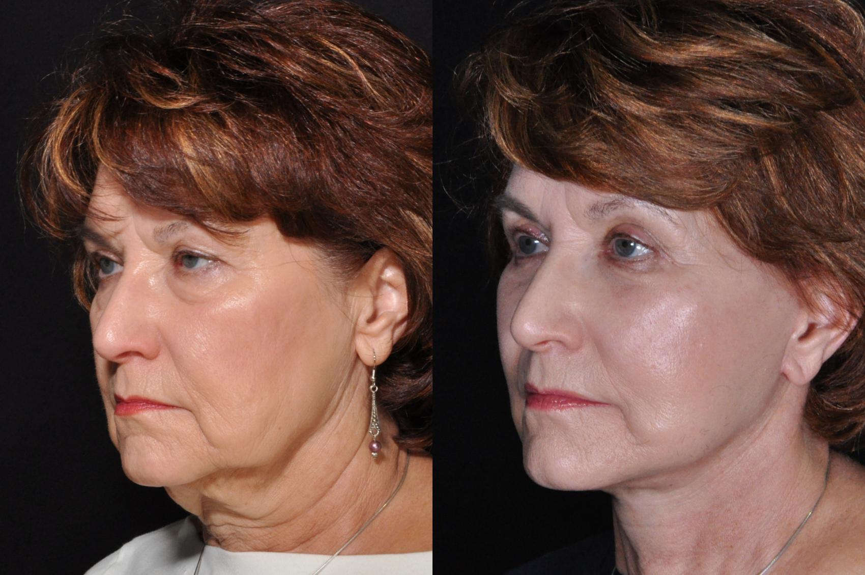 Before & After Facelift Case 520 View #1 View in Panama City & Pensacola, Florida