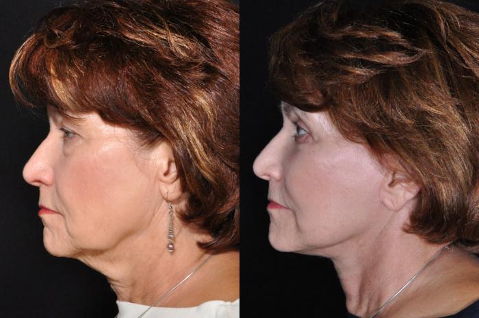 Before & After Facelift Case 521 View #1 View in Panama City & Pensacola, Florida