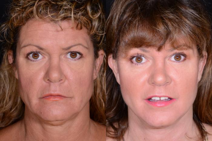 Before & After Facelift Case 522 View #1 View in Panama City & Pensacola, Florida