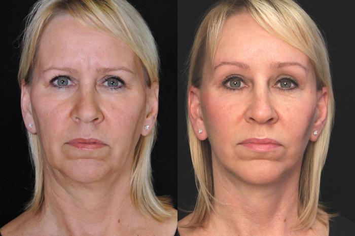 Before & After Facelift Case 532 View #1 View in Panama City & Pensacola, Florida